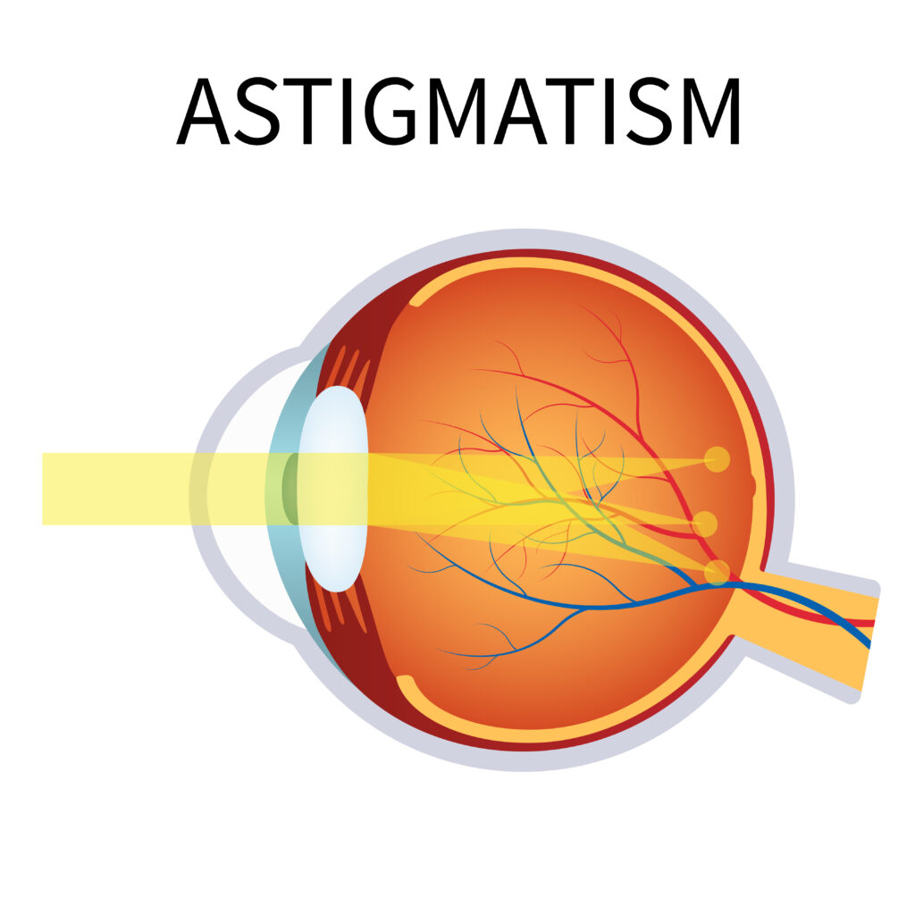 astigmatism toronto