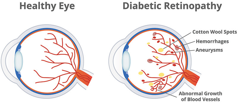 Chart illustrating a healthy eye compared to one with diabetic retinopathy