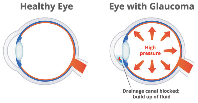 Chart illustrating a healthy eye compared to one with glaucoma