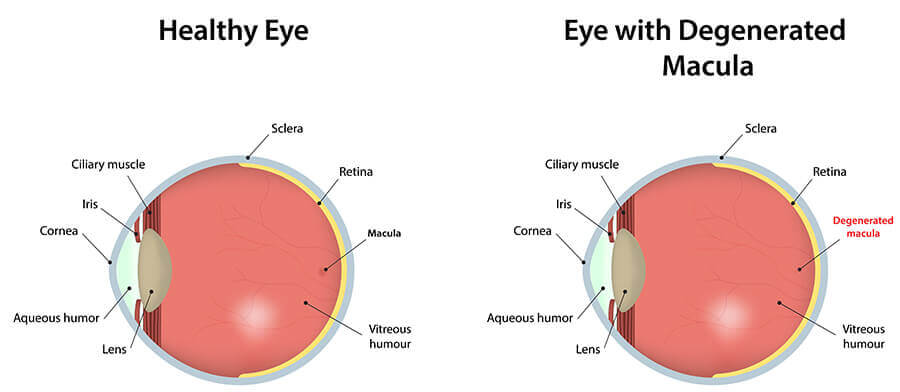 Chart illustrating a healthy eye compared to one with a degenerated macula