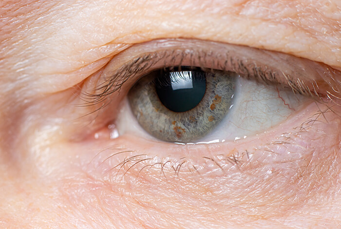 Closeup of Ptosis